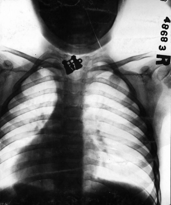 Fbdy 914, the case of E.R.S., age 4, a pair of toy opera glasses in esophagus. Radiologist, Dr. Willis F. Manges (1876-1936). From the Collection of the Mutter Museum, The College of Physicians of Philadelphia.