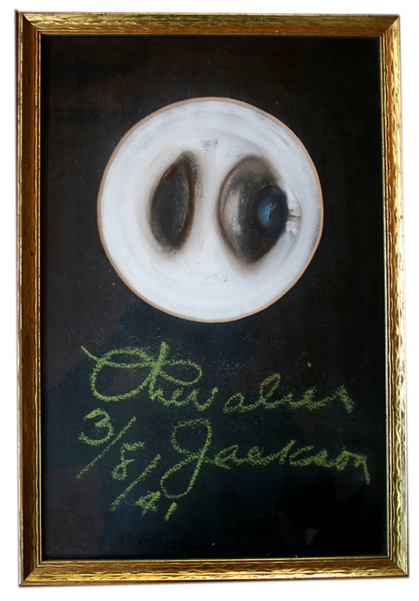 Chevalier Jackson Chalk Talk illustration of a foreign body (apparently a marble) caught in a bronchus. From the estate of Dr. B. Thomas McMahon, Courtesy of Dr. Nancy W. McMahon. (Jean Walton photograph)